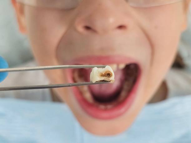 Best Urgent Care for Lost Fillings or Crowns in Okemos, MI